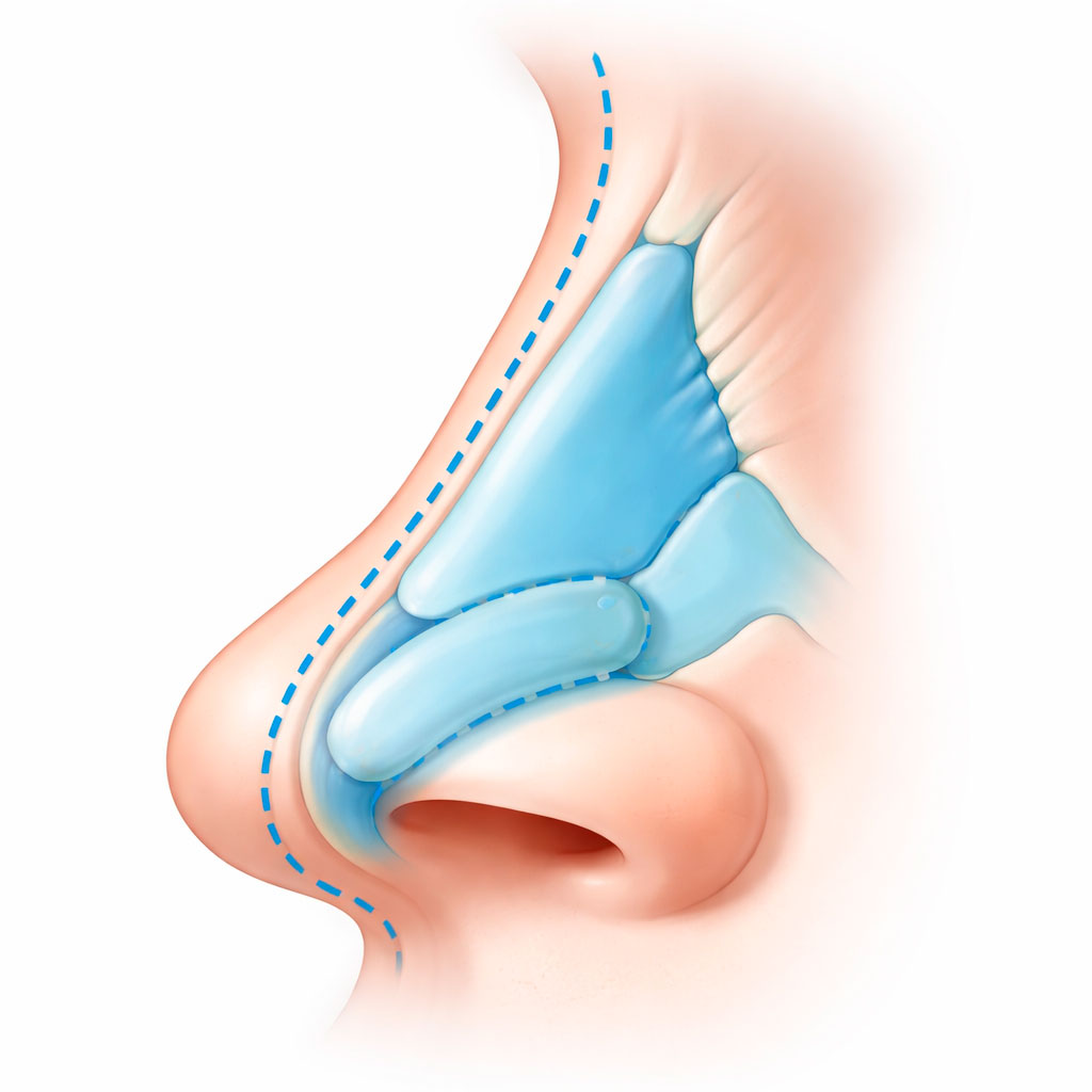 Schiefe Nase nach Nasenoperation &ndash; Darstellung der Nasenachse